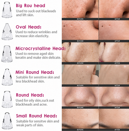 Premium Multi-Functional Black & Whitehead Remover For Pore & Pimples Cleaner Machine Men & Women